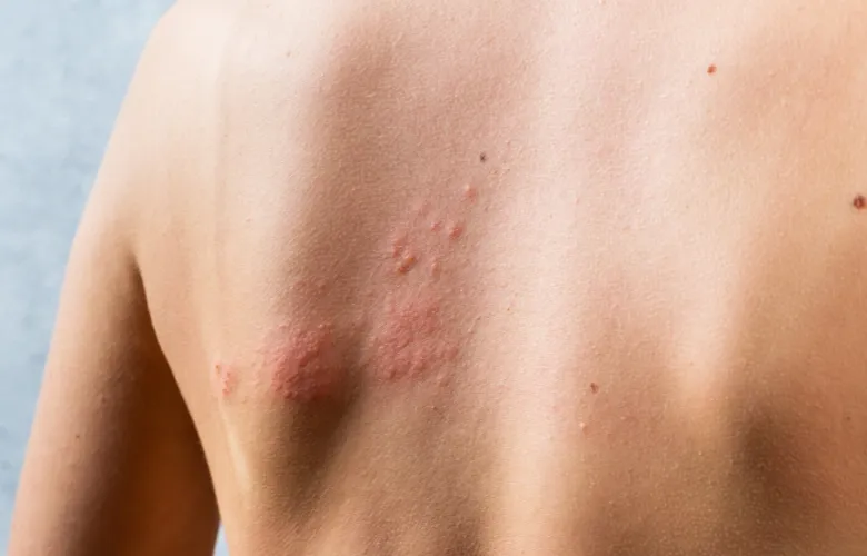 Herpes Zóster é contagioso? Saiba quais são os sintomas e formas de transmissão